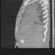 Percutaneous endoscopic gastrostomy, PEG: CT - Computed tomography